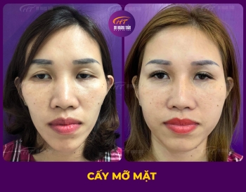 CẤY MỠ